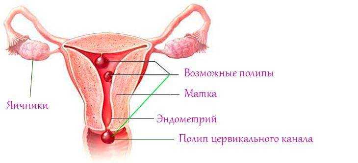 Полипы матки: причины, симптомы, методы диагностики и лечения полипов матки.