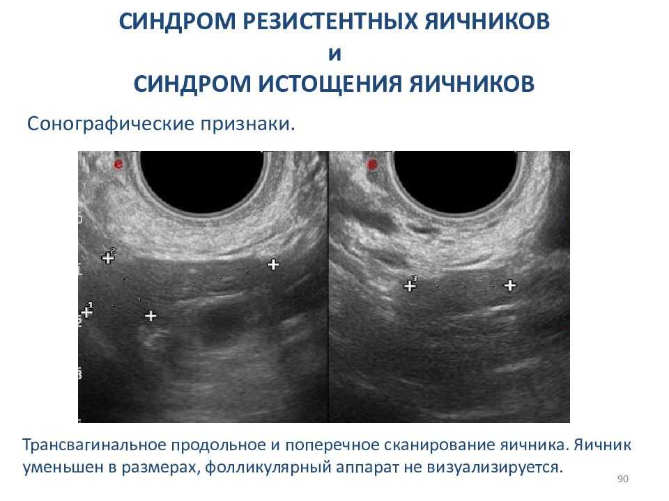 Фолликулярные яичники и задержка месячных. Преждевременная недостаточность яичников УЗИ. Синдром истощения яичников УЗИ. Обеднение фолликулярного аппарата яичников. УЗИ при синдроме истощения яичников.