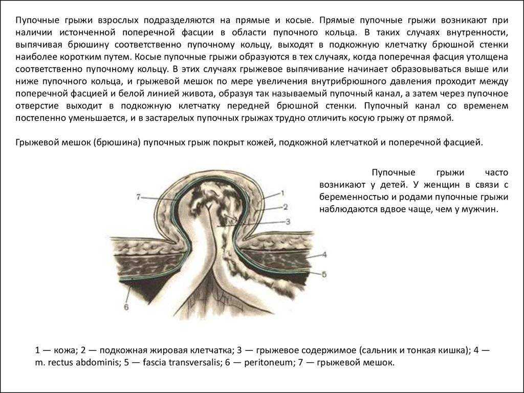 Грыжа пупочная