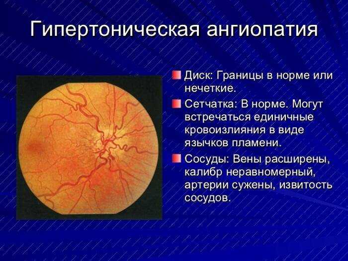Ангиопатия сетчатки глаза: причины, симптомы и лечение ангиопатии сосудов сетчатки - medside.ru