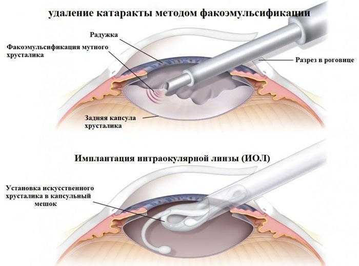 Лечение катаракты цена операции
