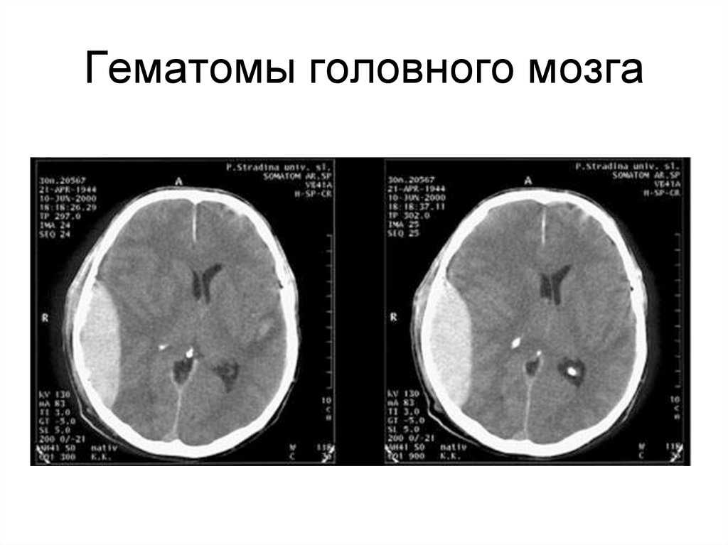 Кровоподтеки: как возникают – травматические и патологические, клиника, как лечить
