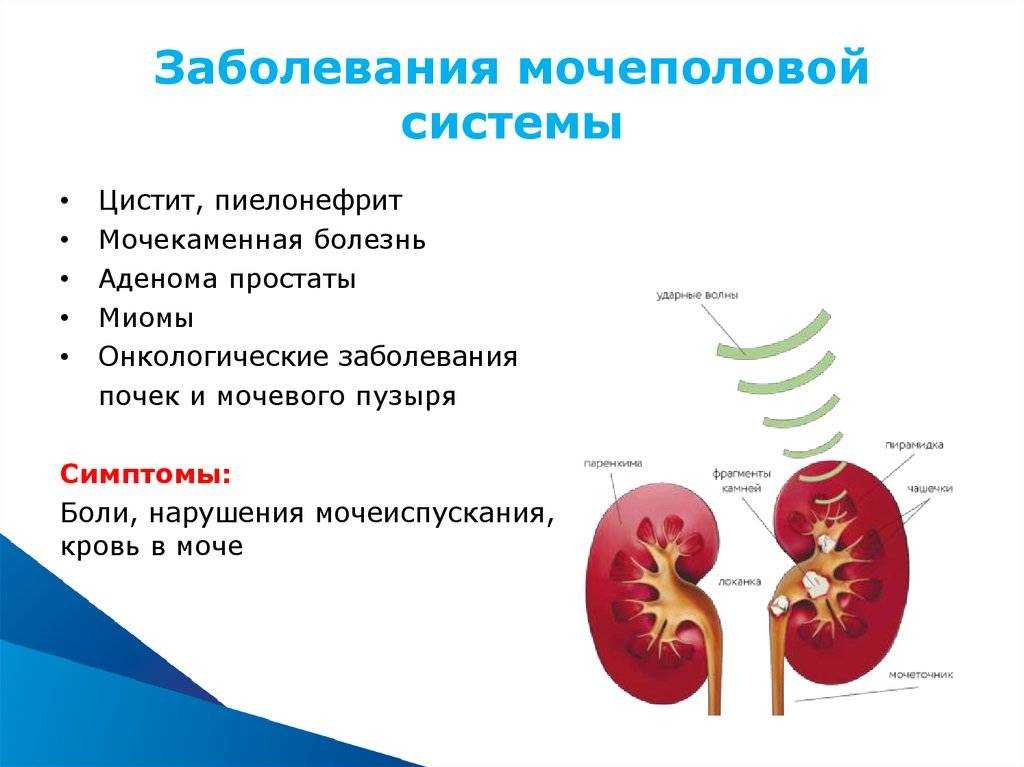 Воспалительные заболевания почек презентация