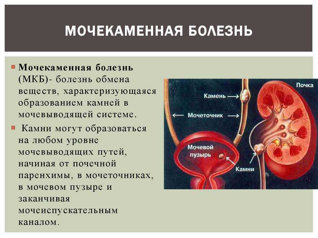 Откуда берутся камни в почках и что с ними делать?