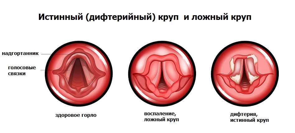 Дифтерия — s class wiki
