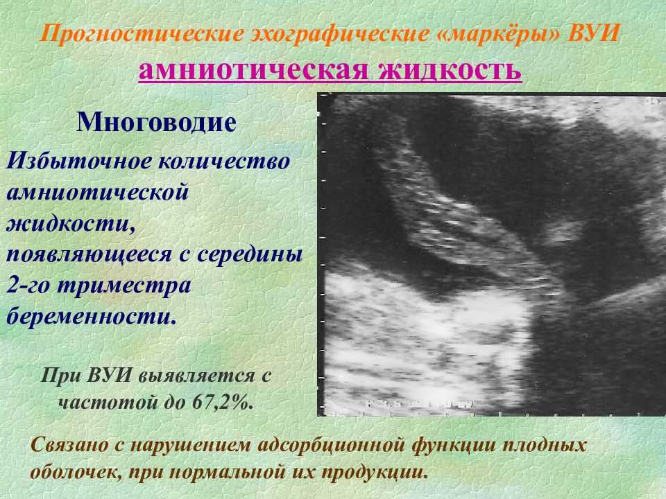 Маловодие при беременности