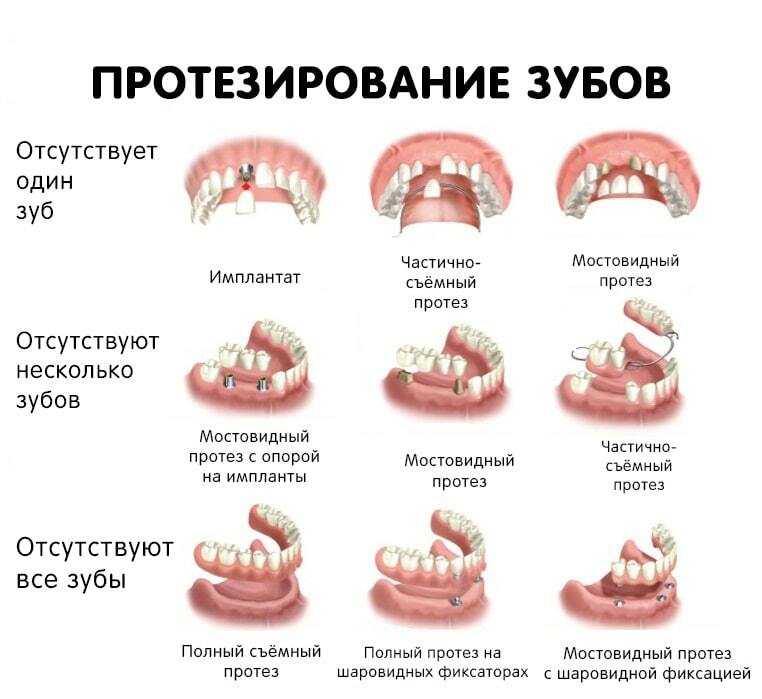 Протезирование зубов. виды зубных протезов: их различия и преимущества